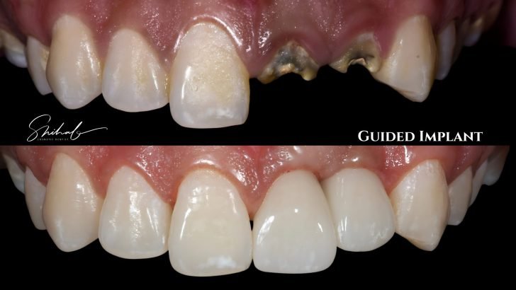 Digital Dental Implant in Bangladesh