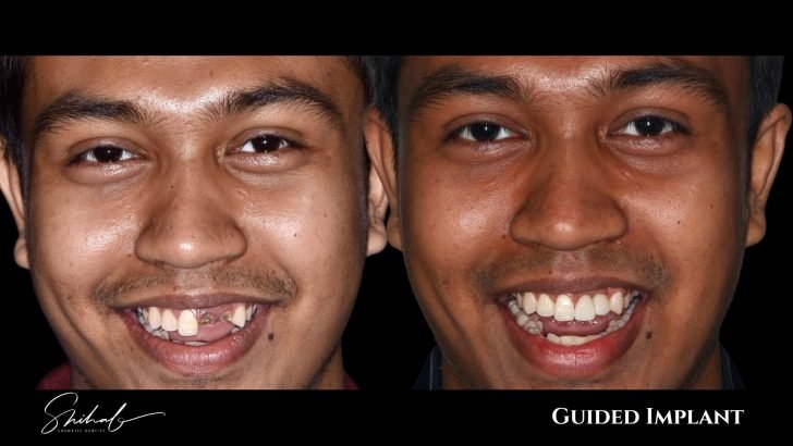 Best dental implant treatment in Bangladesh