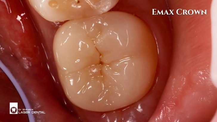 Emax crown for teeth