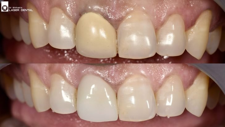 Before and after photo of dental crown in Bangladseh