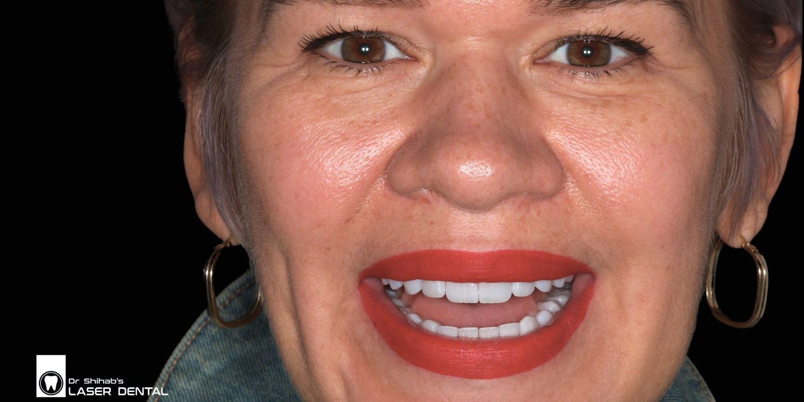 Digital smile design_best dentist Smile makeover with dental veneers
