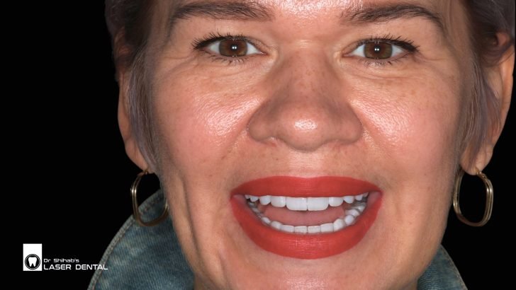 Smile makeover with dental veneers