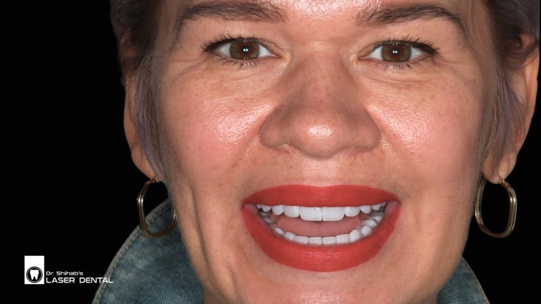 Digital smile design_best dentist Smile makeover with dental veneers