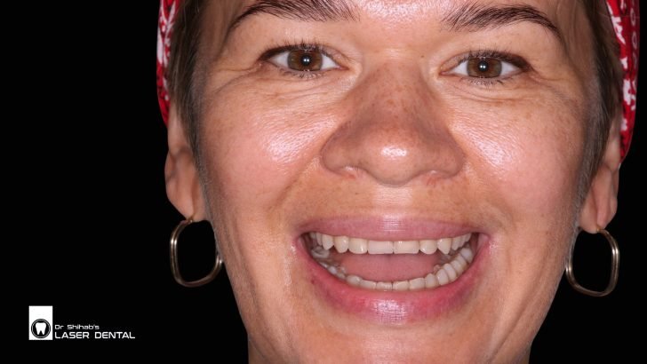 Before Difgital Smile Design treatment
