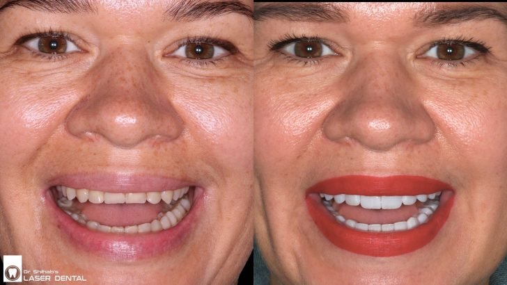 Before After Image Comparison for Emax Veneers_Porcelain Veneers