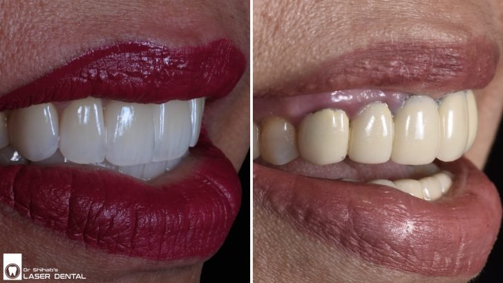 LASER DENTAL – Leading Cosmetic Dentist in Banani & Uttara for Veneers, Crowns & Smile Makeovers