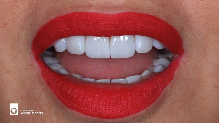 High-Quality Emax Crowns for Damaged Teeth – LASER DENTAL, Dhaka’s Top Cosmetic Dentist