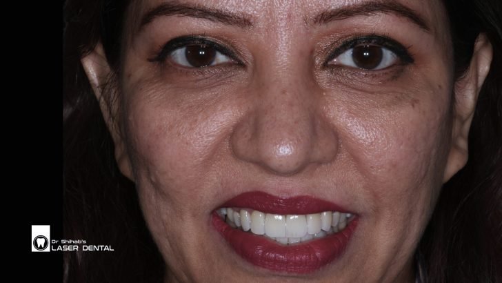 Before & After Emax Veneers Transformation at LASER DENTAL, Banani – Natural & Stain-Resistant Smile