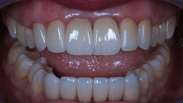 Full Mouth Reconstruction with Emax Crowns – Restored Function & Aesthetics at LASER DENTAL
