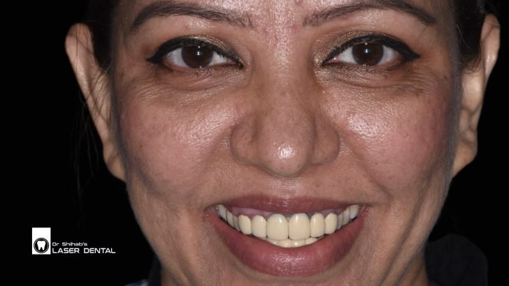 Natural-Looking Metal-Free Crowns at LASER DENTAL Banani – Durable & Aesthetic Results