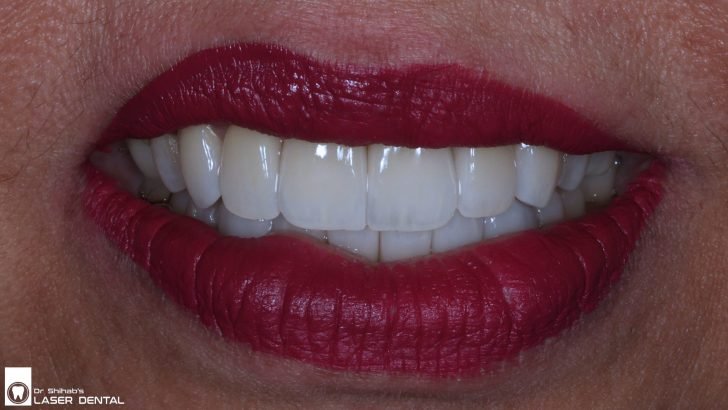 Minimally Invasive Veneers for a Flawless Smile – Best Cosmetic Dentist in Dhaka