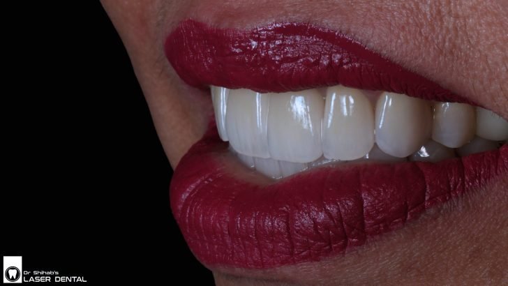 Pain-Free Veneers & Crowns – Comfortable Cosmetic Dentistry in Uttara
