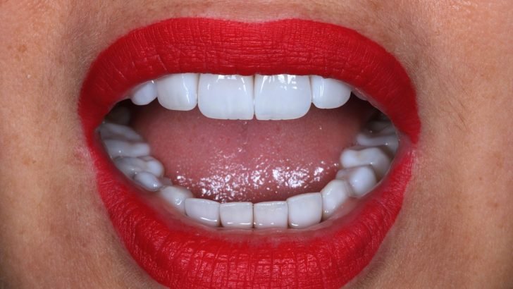 Stunning Porcelain Veneers Results at LASER DENTAL, Uttara – Perfectly Aligned & Bright Teeth