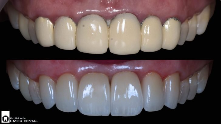 Porcelain Veneers for Closing Gaps – Instant Smile Upgrade at LASER DENTAL, Banani