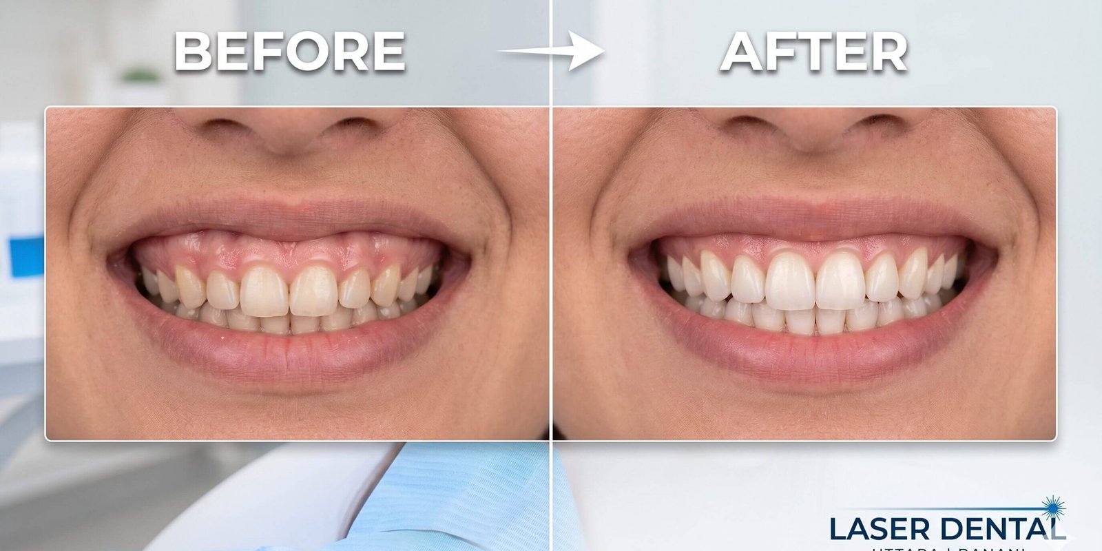 Correcting Gummy Smiles: The Laser Gum Lift. Correcting Gummy Smiles: The Laser Gum Lift.