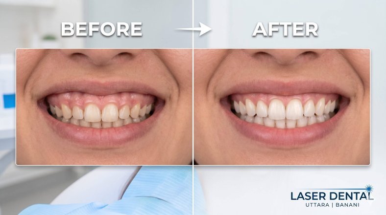 Correcting Gummy Smiles: The Laser Gum Lift. Correcting Gummy Smiles: The Laser Gum Lift.