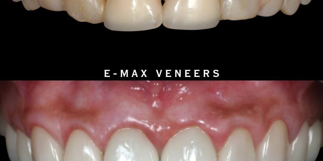 cosmetic-dentistry-smile-transformation-after-root-canal-failure-dhaka