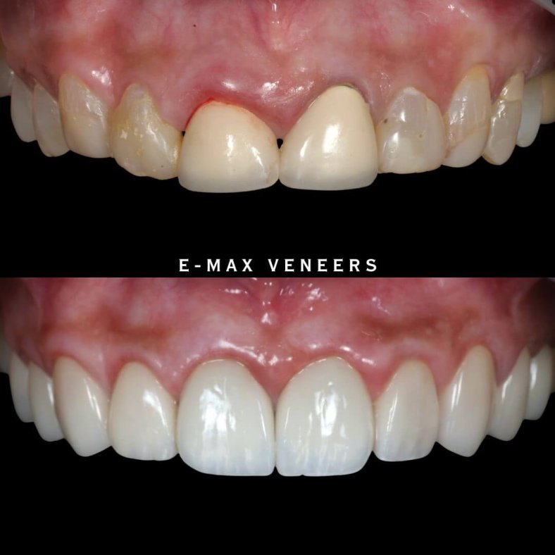 cosmetic-dentistry-smile-transformation-after-root-canal-failure-dhaka