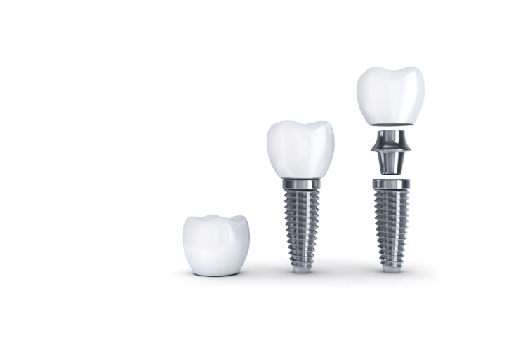 Dental Implant at LASER DENTAL in Uttara