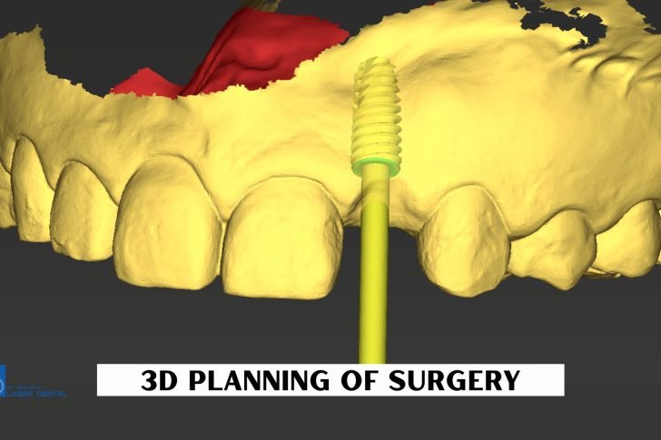 Digital planning for guided dental implant surgery