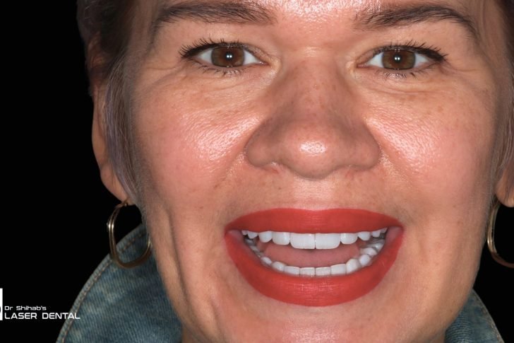 Smile makeover with dental veneers