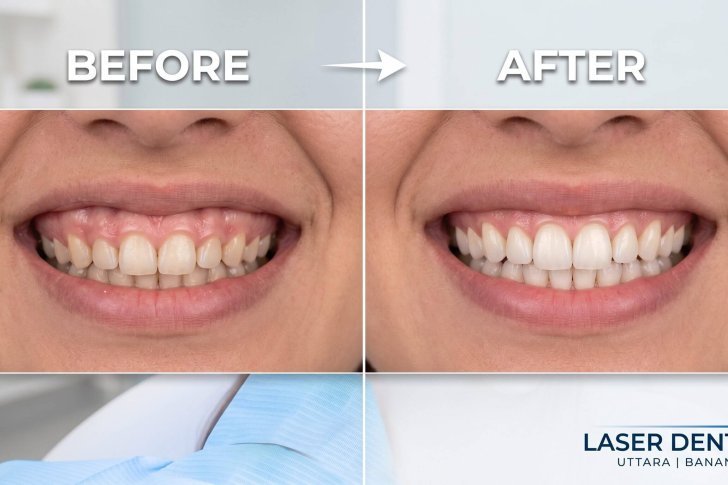 Correcting Gummy Smiles: The Laser Gum Lift.